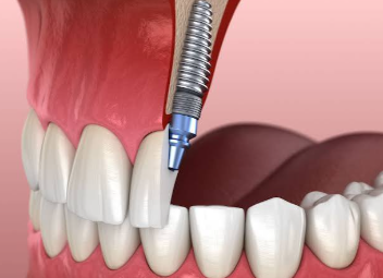 3 Things That Can Delay Dental Implant Healing