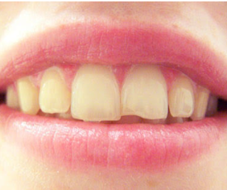 5 Things To Do Immediately After You Chip A Tooth