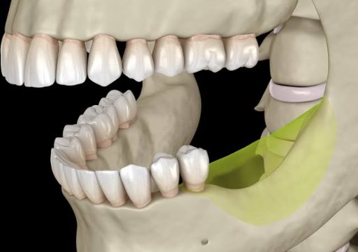 Bone Loss Around Teeth: How Periodontists Stop It From Progressing