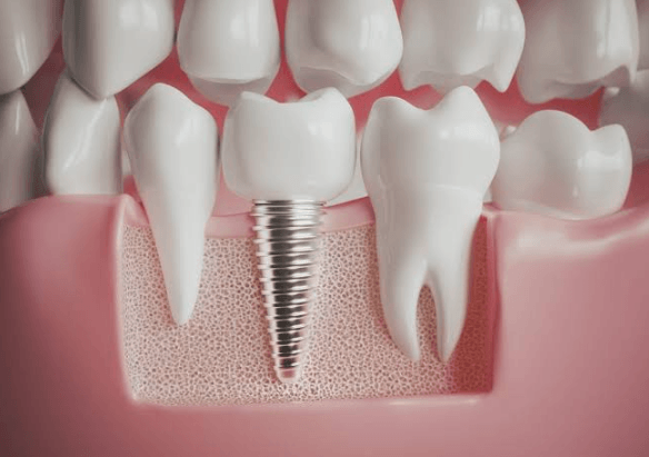 Implant Dentistry For Front Teeth: Balancing Strength, Shape, And Gum Aesthetics