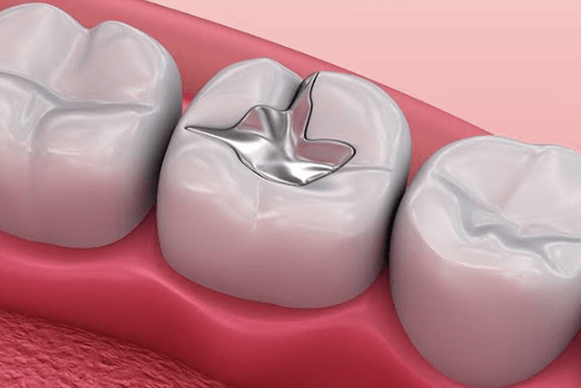 How Tooth Colored Fillings Enhance Both Health And Appearance