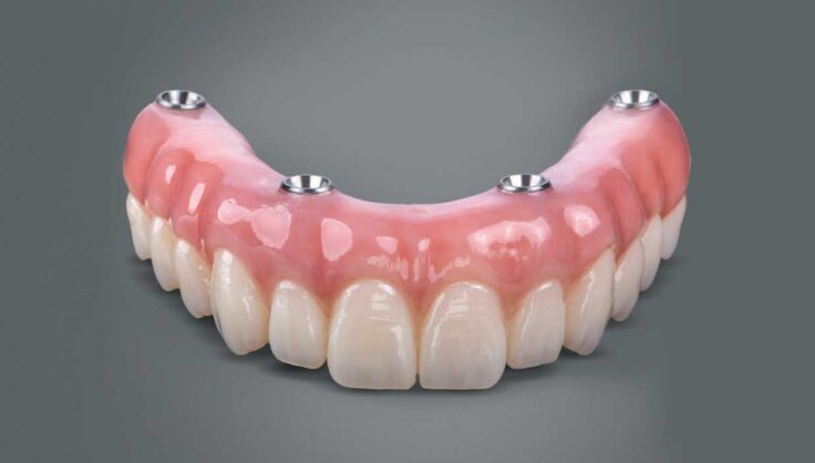 What Patients Should Know About Pink Ceramic Near Implant Restorations
