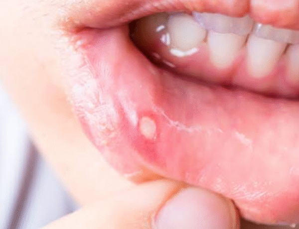 How General Dentistry Helps Patients Manage Recurring Mouth Sores