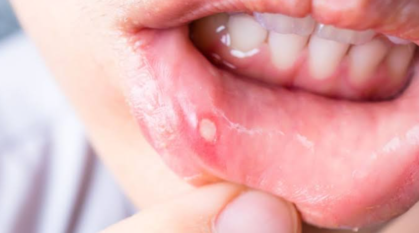 How General Dentistry Helps Patients Manage Recurring Mouth Sores
